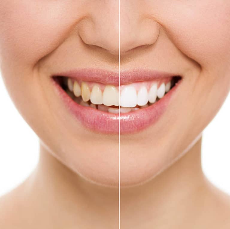 tooth-whitening-jason-hamel-dmd-cosmetic-dentist-augusta